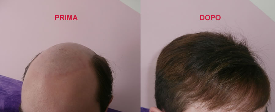 parrucche per alopecia femminile